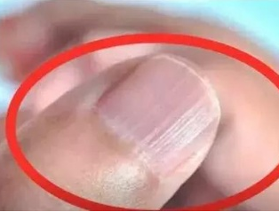 黄色茄子视频厂家分析手指甲有竖纹的根本原因 黄色茄子视频厂家分析手指甲有竖纹的根本原因