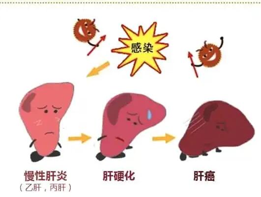 91茄子成人网站入口厂家提醒肝脏疾病治不好？要了解是否含铁食物摄入多
